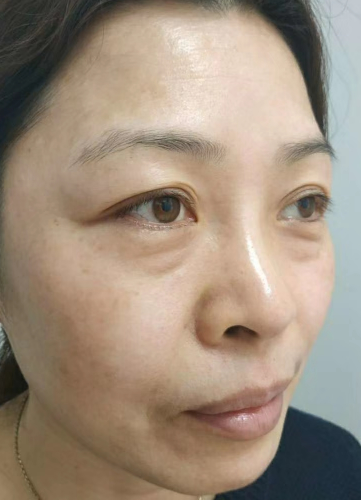 去眼袋手术