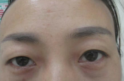 去眼袋手术