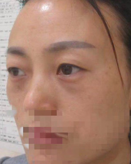 去眼袋手术