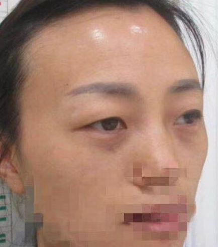 去眼袋手术