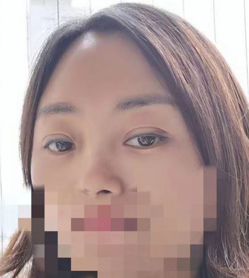 去眼袋手术