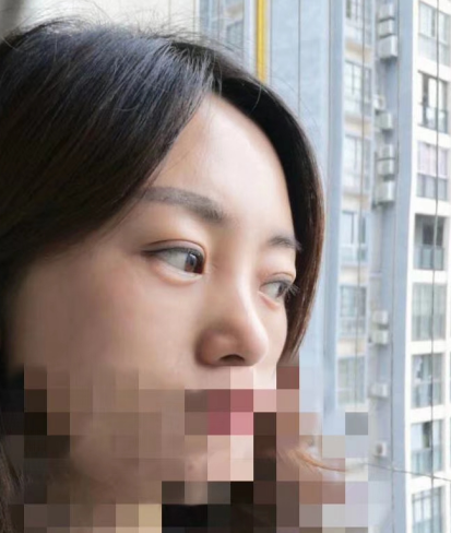 去眼袋手术