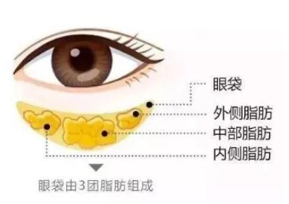 去眼袋手术