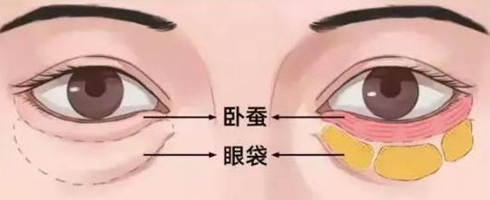 去眼袋手术