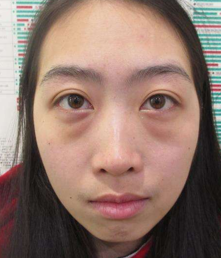 去眼袋手术