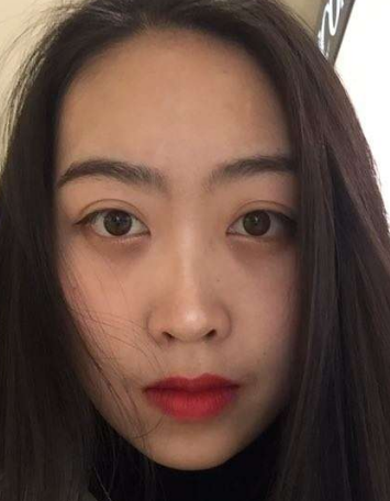 去眼袋手术