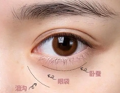 去眼袋手术