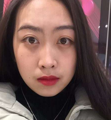 去眼袋手术