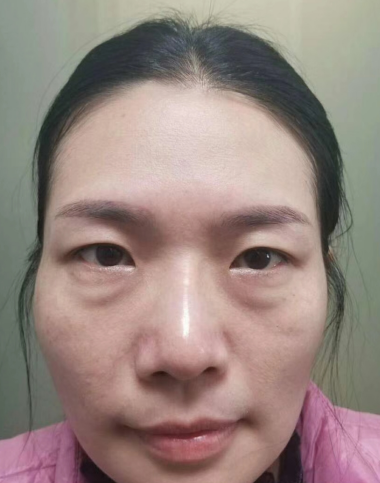 去眼袋手术