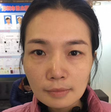 去眼袋手术