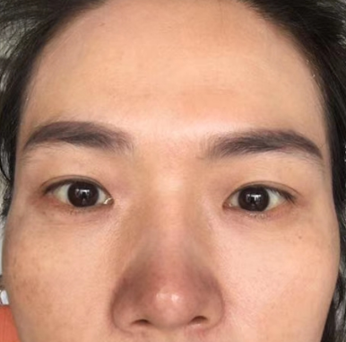去眼袋手术