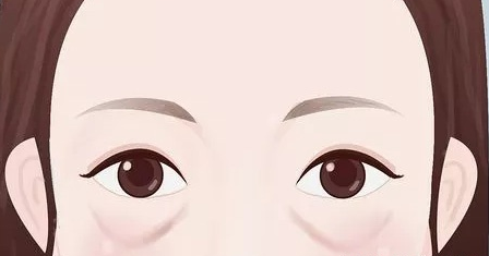 去眼袋手术