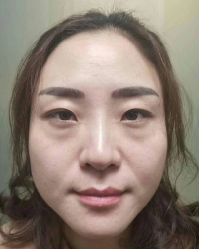 去眼袋手术