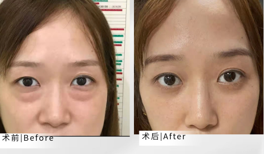 去眼袋手术