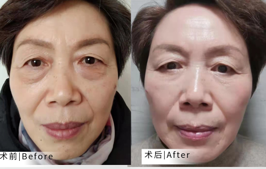 去眼袋手术