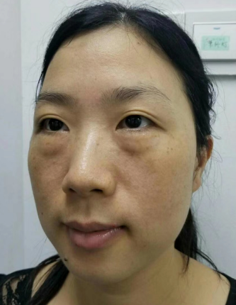 去眼袋手术