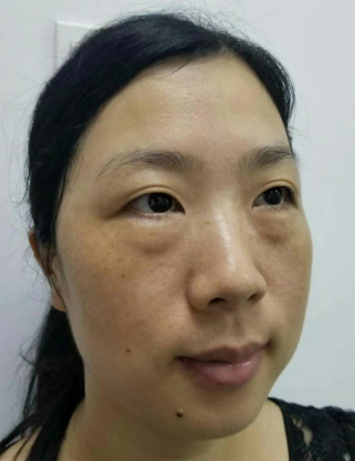 去眼袋手术