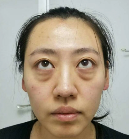 去眼袋手术