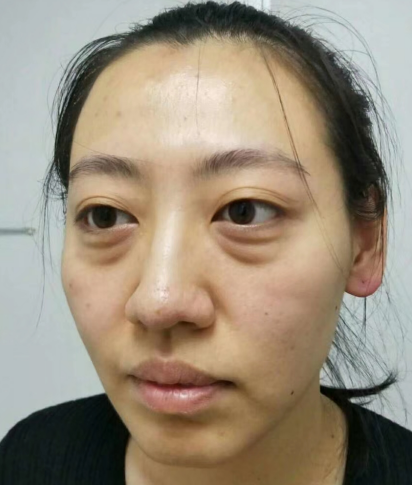 去眼袋手术