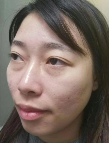 去眼袋手术