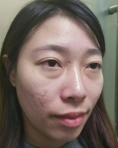 去眼袋手术