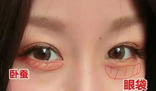 去眼袋手术