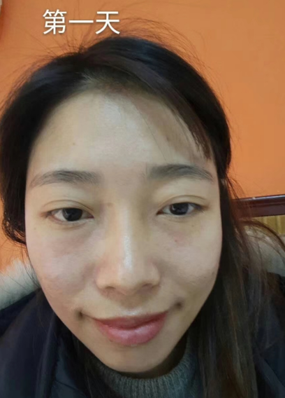 去眼袋手术