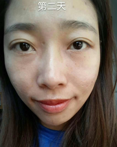 去眼袋手术