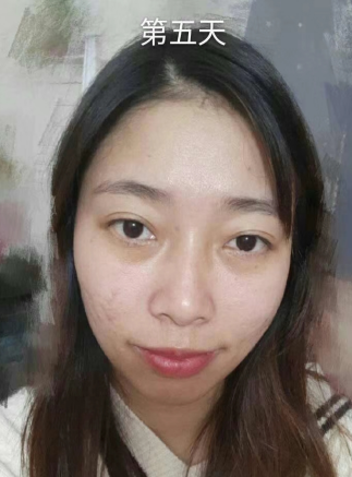 去眼袋手术