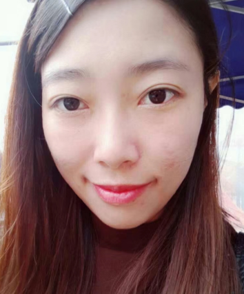 去眼袋手术