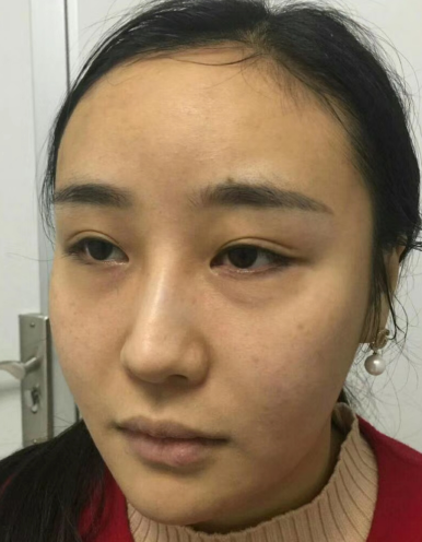 去眼袋手术