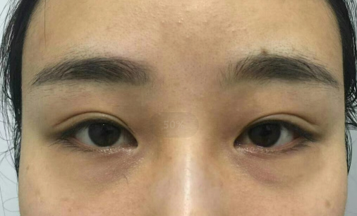 去眼袋手术