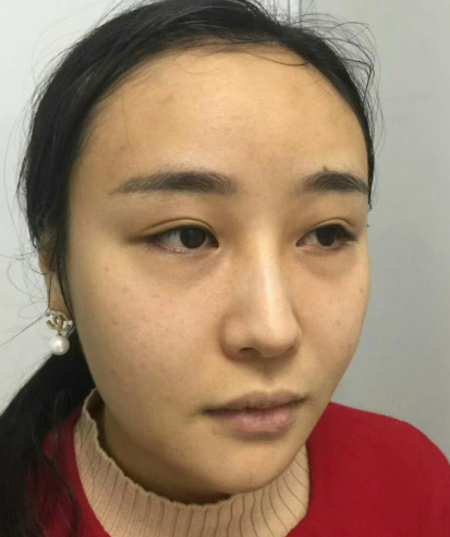 去眼袋手术
