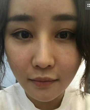 去眼袋手术