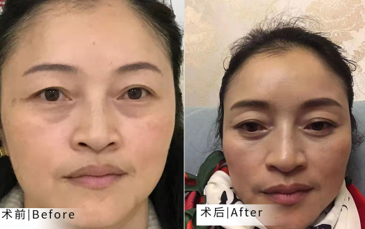 去眼袋手术