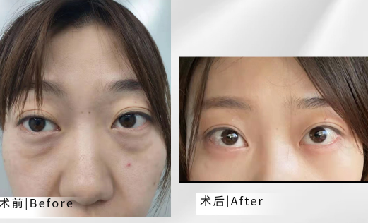 去眼袋手术