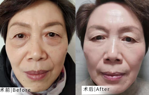 去眼袋手术