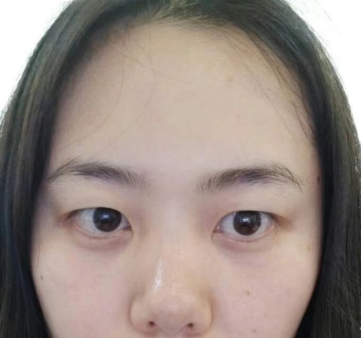 去眼袋手术