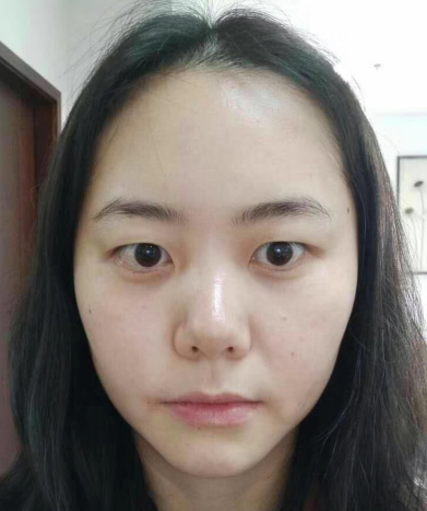 去眼袋手术