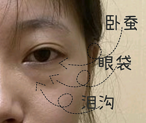 去眼袋手术