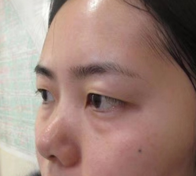 去眼袋手术