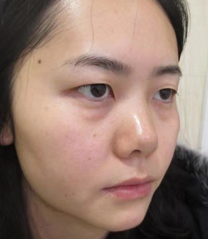 去眼袋手术