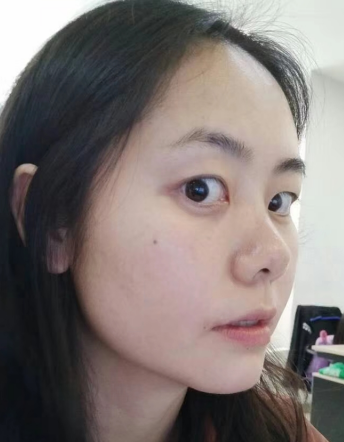 去眼袋手术