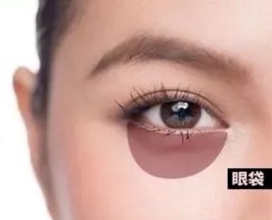 去眼袋手术