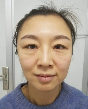 去眼袋手术