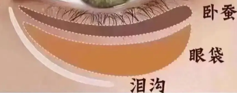 去眼袋手术