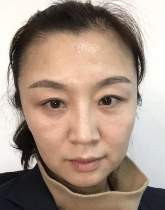 去眼袋手术