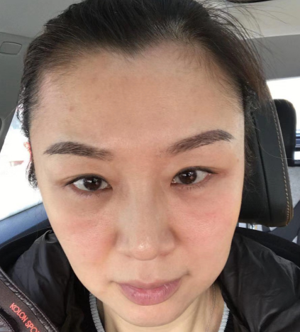 去眼袋手术