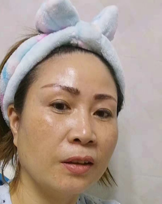 去眼袋手术