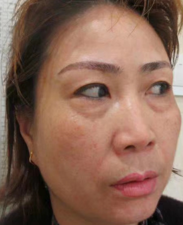 去眼袋手术